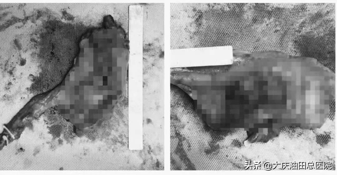 84岁老人直肠癌微创手术,直肠癌手术成功无转移