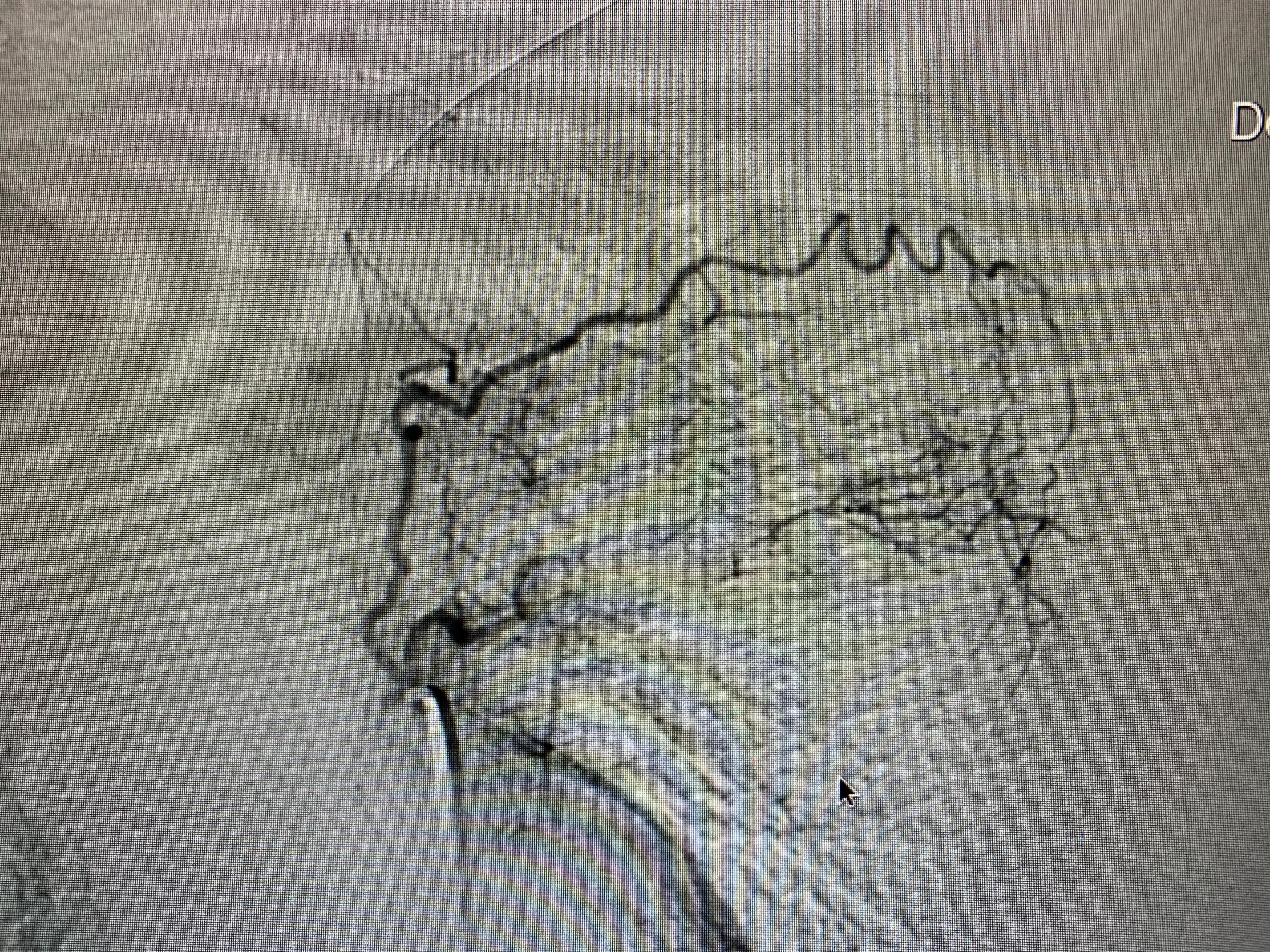 肺癌栓塞的介入治疗,84岁老人患肺癌可以做微创介入吗