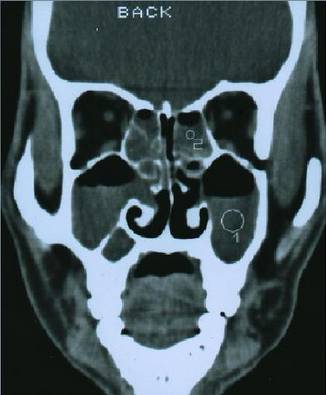 慢性鼻窦炎药物治疗原则,慢性鼻窦炎初步诊疗措施