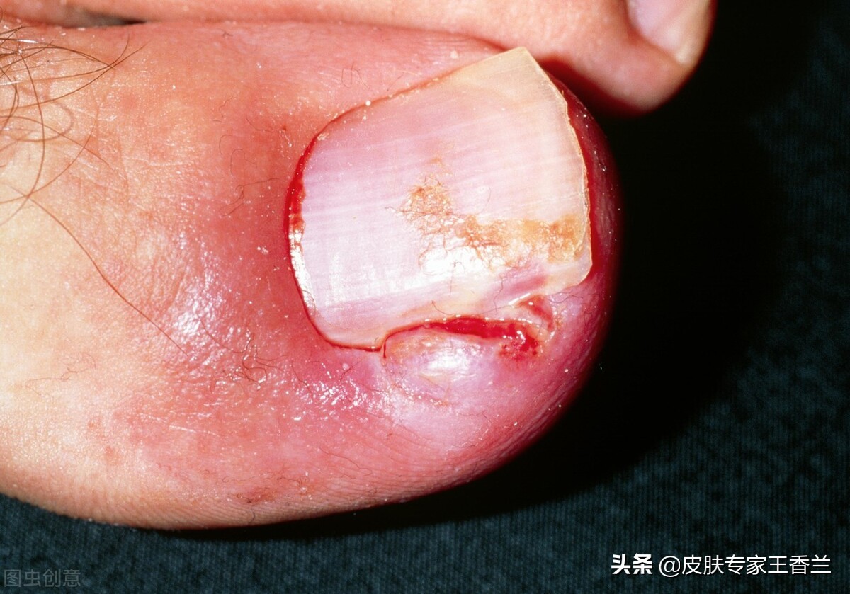 拔倒刺引起甲沟炎用什么药,甲沟炎不是嵌甲怎么办