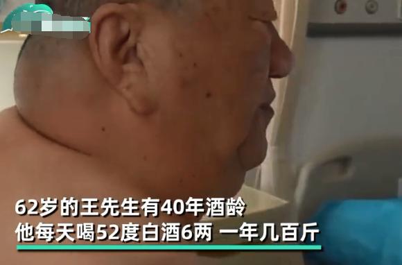 辽宁大叔喝酒40年后续,喝酒三十年喝出河马脖