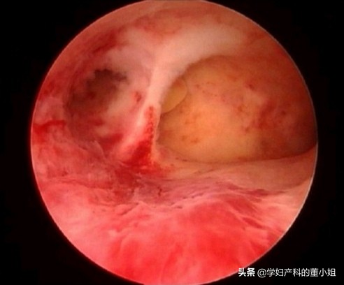 我怀孕了流产了,我怀孕了自己流掉了还需要清宫吗