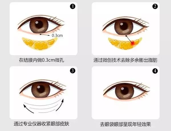 有眼袋怎么办按摩去眼袋,去眼袋眼霜真能去眼袋吗