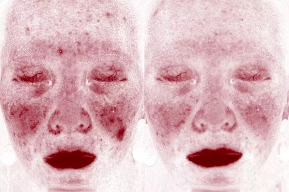 褐斑的原因及治疗方法,褐斑的原因和治疗方法