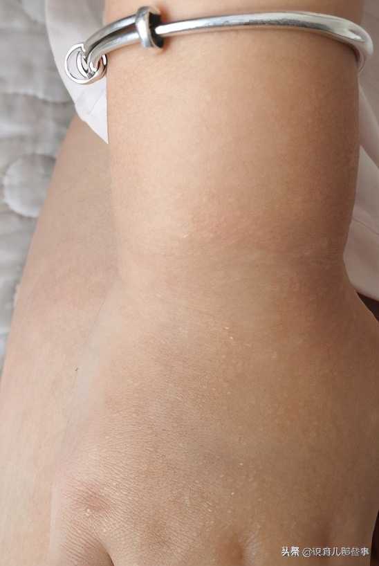 最奇葩的过敏图片,各种各样的过敏图片