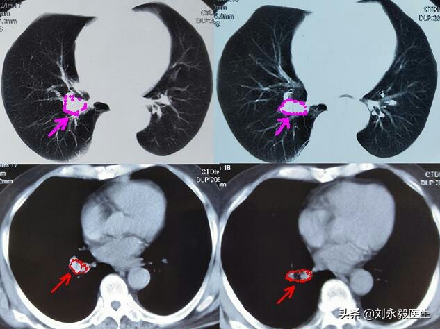 肺癌能治愈吗花多少钱,肺癌能治愈吗中医