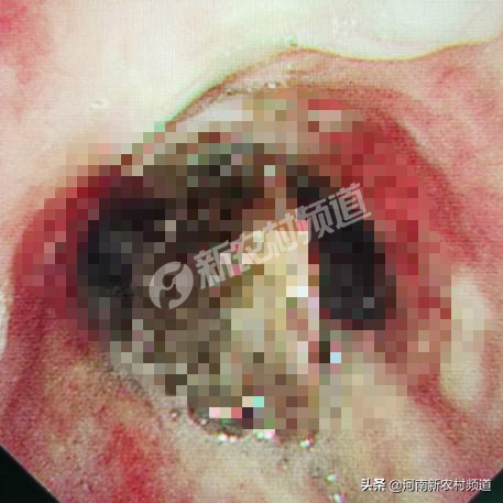 72岁老人误吞枣核后续,81岁老人误吞杏核