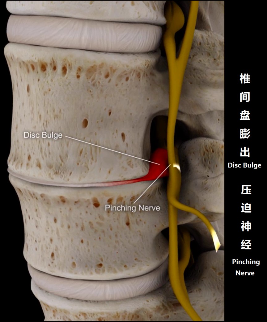 介绍一下治腰痛小窍门,不同腰痛的诊断与治疗