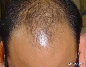 脱发真的没有治疗的方法吗,脱发严重真的没救了吗