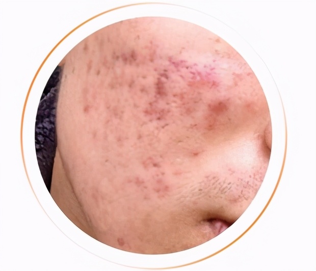 祛除疤痕痘印痘坑药膏,祛除痘印痘坑护肤品