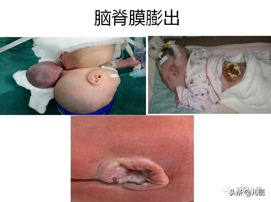 要是不打疫苗有事吗,不打疫苗对住院有影响么