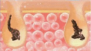 去黑头小窍门轻轻松松黑头一扫光,黑头太顽固教你去黑头的方法