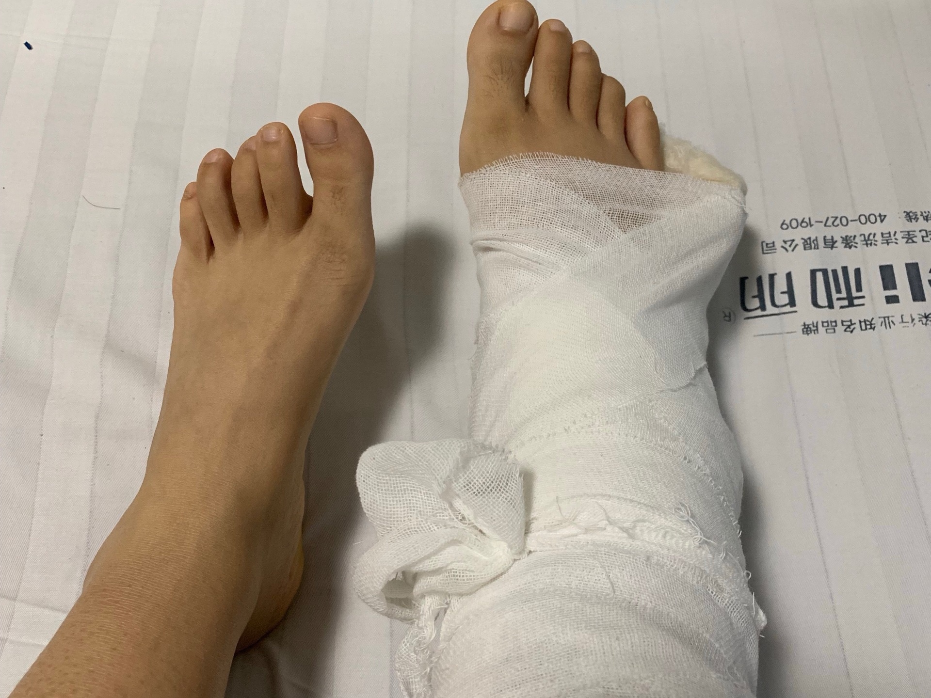 得了甲沟炎就要去修脚吗,得了甲沟炎必须得拔甲吗