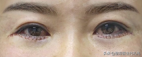 祛眼袋十问十答,提眉祛眼袋泪沟脂肪填充后