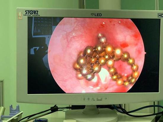 14岁男孩将53颗巴克球塞入尿道，次日中午发现自己上厕所时出血，引发失血性休克