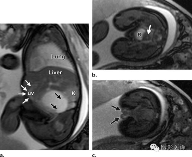 孕早期卵巢囊肿边界清形态规则,孕期卵巢囊肿呈液性伴点状回声