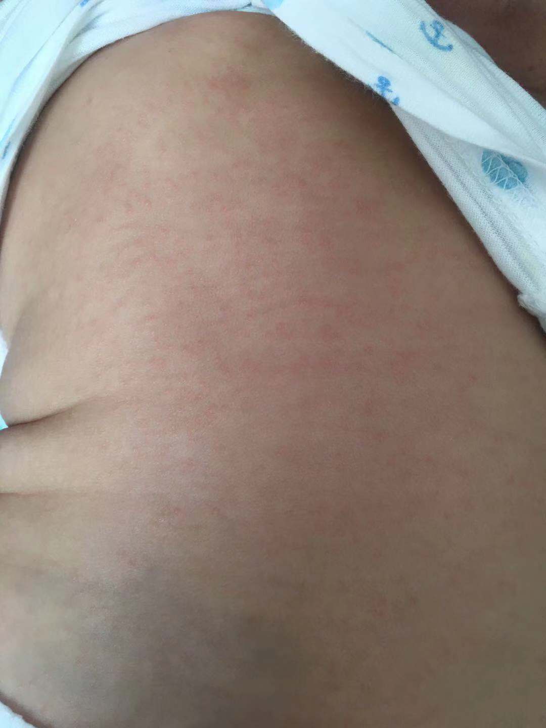 新生儿湿疹怎么护理,湿疹宝宝护理经历