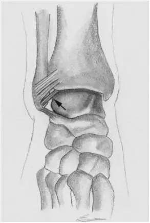 踝关节撞击症问诊,踝关节撞击综合征的x线表现