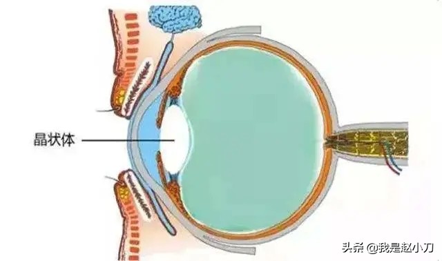 赵小刀白内障手术,先天性瞳孔残膜手术需要多少钱