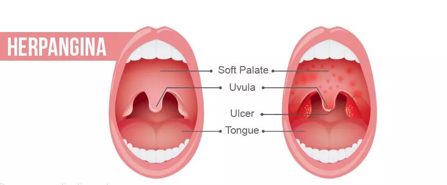 疱疹性咽峡炎进入爆发期！最实用的防护办法在这里