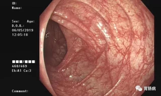 担心做胃肠镜会被感染？来看看内镜是怎么消毒的