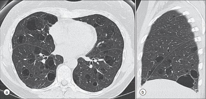 干燥综合症最怕的三种食物,干燥综合症的8大临床特征