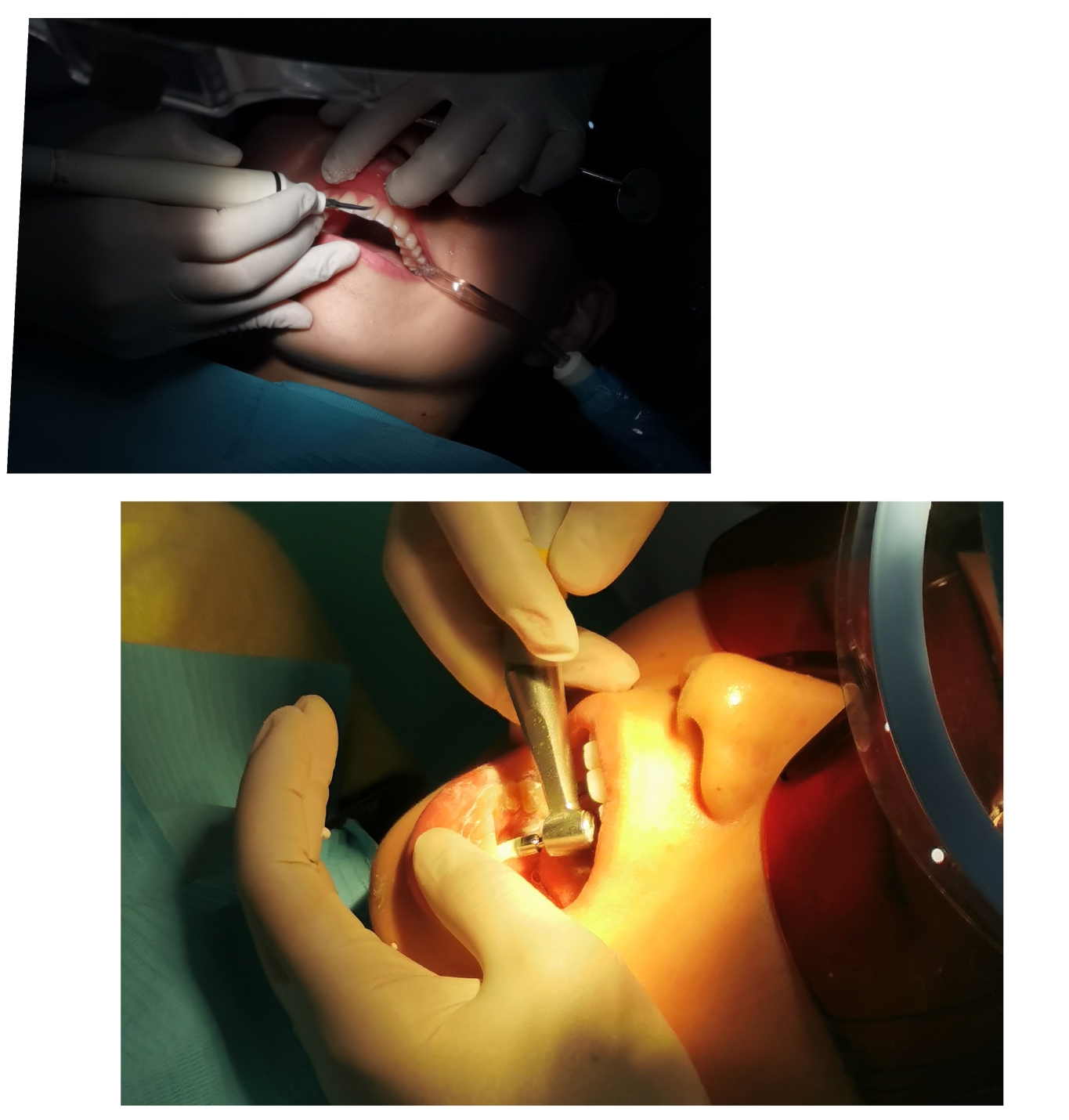 25岁第一次洗牙全过程,40年第一次洗牙的真实感受