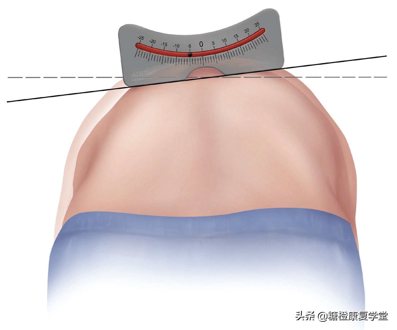 最常见的脊柱侧弯,这样运动治疗,效果明显