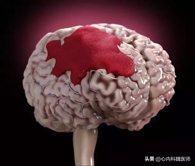 血压高突发脑出血怎么治疗30岁,高血压脑出血的前兆如何急救