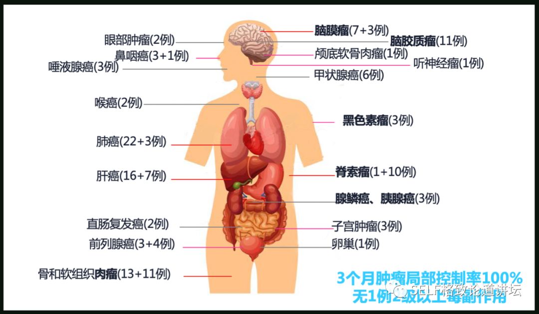 这个装置成功辅助我国两弹爆炸，现在它能治疗肿瘤
