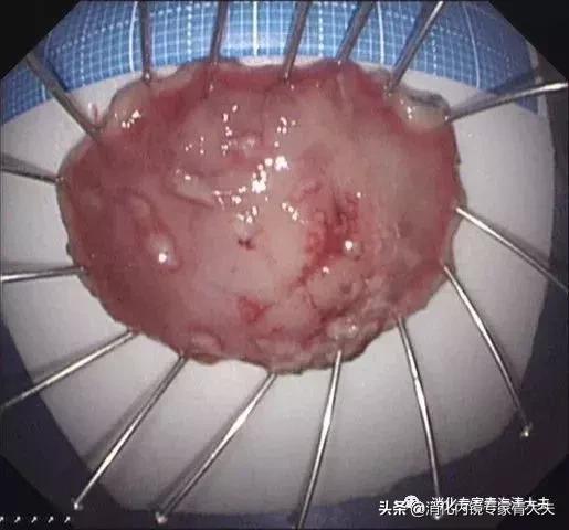 通过科普文章求治的一例胃窦后壁早癌