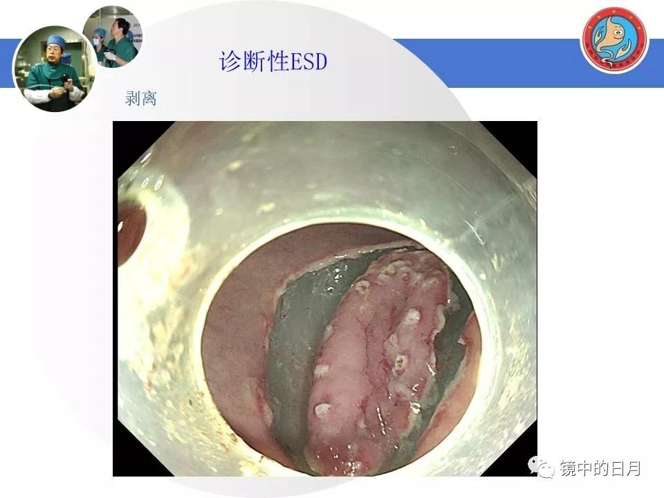 低分化胃癌早期时候做内镜手术吗,早期胃癌内镜手术后追加外科手术