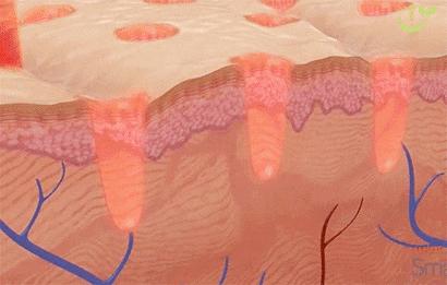 毛孔粗大的原因及改善方法,毛孔粗大的原因和治疗方法