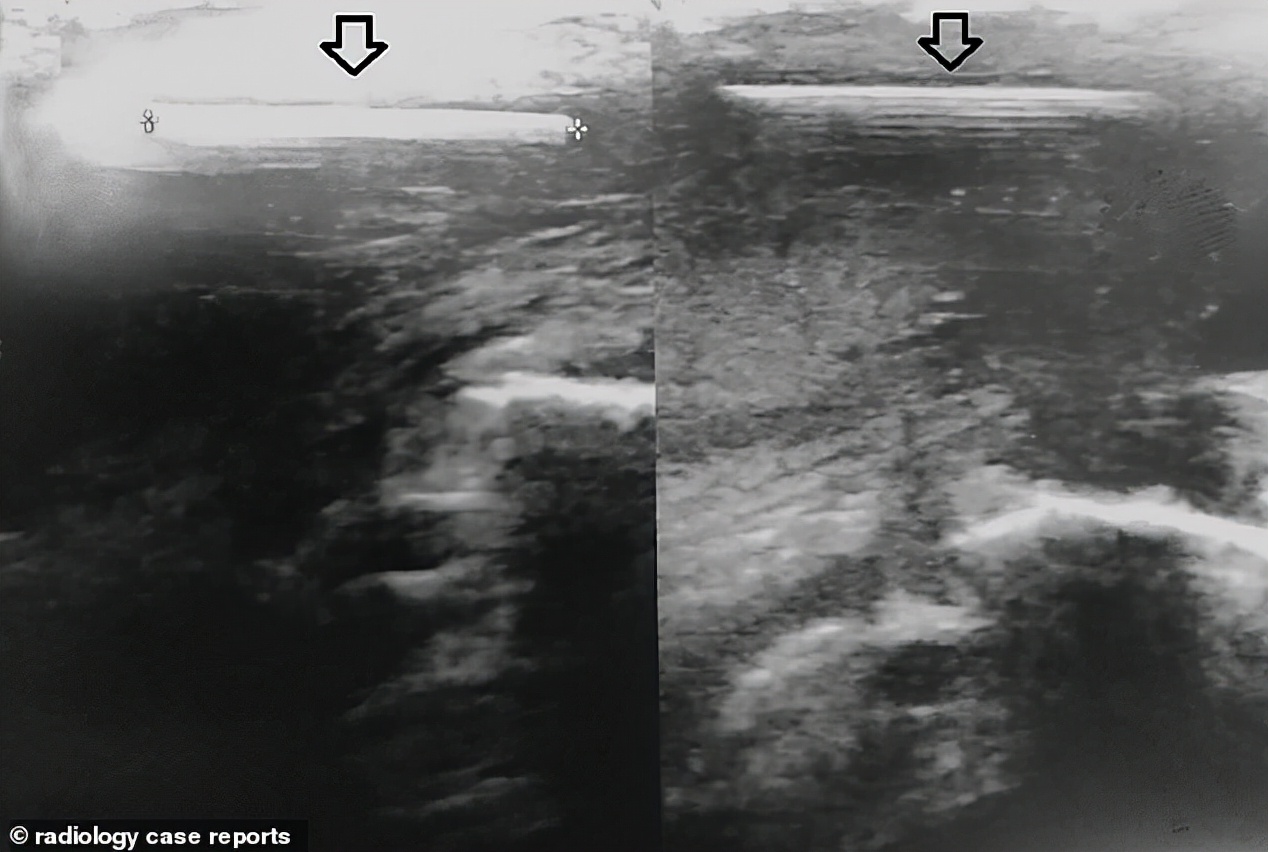 工人不小心打到自己腿,工人被钉枪