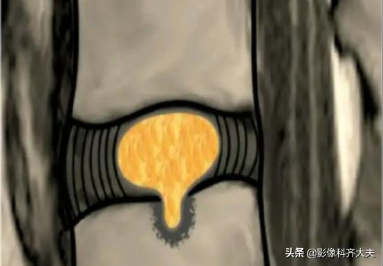 腰椎间盘突出是什么,腰椎间盘突出和腰间盘突出有区别吗