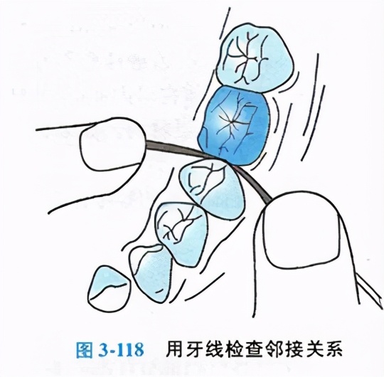 牙体缺损粘接修复术过程,口腔修复学牙体缺损的修复