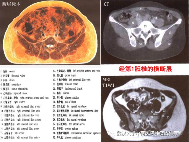 女性盆腔解剖与断层影像