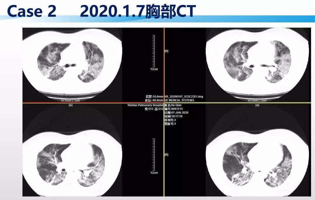 赵建平:重症CAP存在过度炎症反应时合理应用激素可减轻