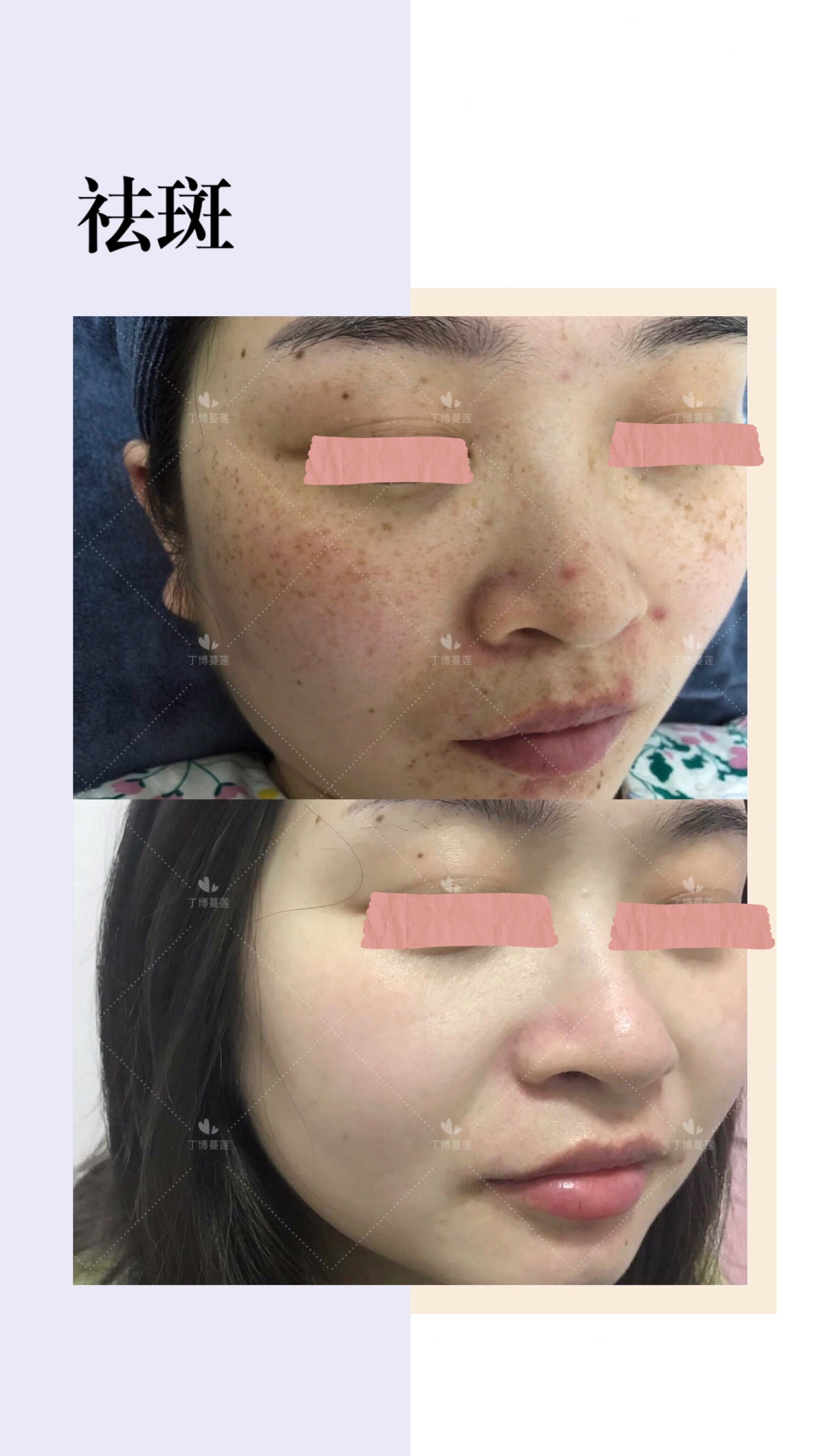 雀斑激光祛斑需要几次才能祛干净,有什么办法可以祛雀斑不反弹