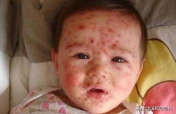 宝宝长水痘怎么处理好得快,小孩子水痘要是没发好会怎么样