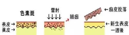 激光祛斑后会复发吗会产生反弹吗,激光祛斑复发