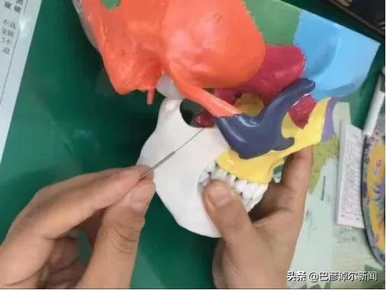 摆脱鼻炎困扰,过敏性鼻炎针刺哪些穴位有效