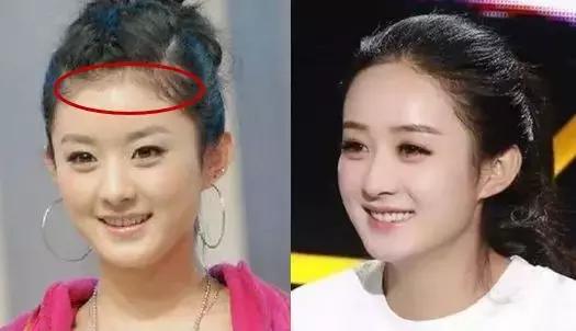 颅顶太低如何自救,颅顶低怎么自救