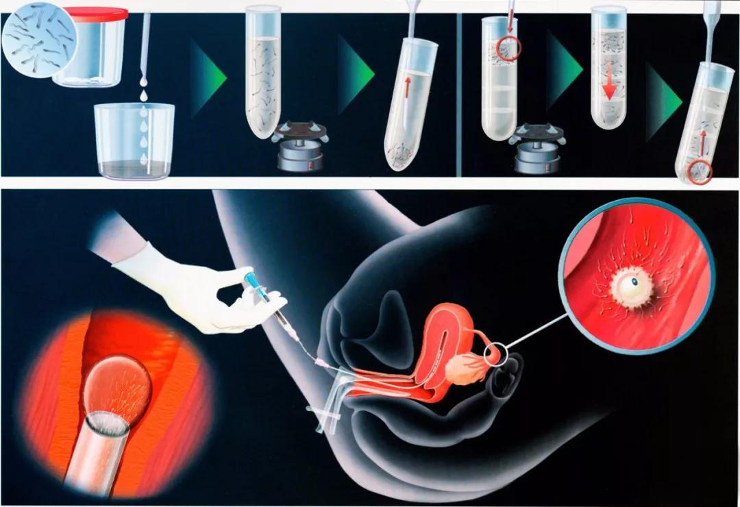 试管精子优化和受精过程,人工试管授精精子从哪里来的