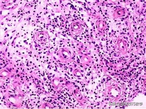 打球崴脚急救措施,打球崴脚了肿了怎么办