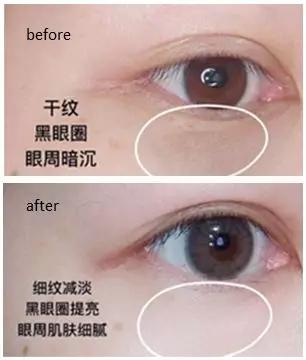 去眼纹去黑眼圈用什么方法,去眼袋黑公认最好用的土方法