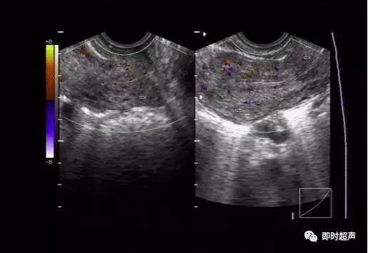 阴部超声检查什么时候做,妇科阴式超声检查方法
