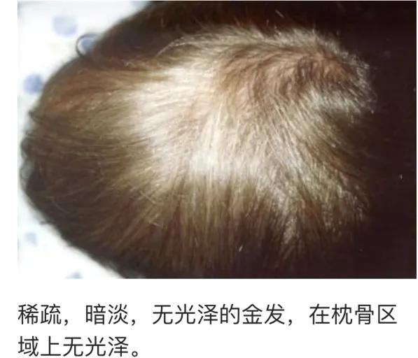 儿童脱发会是什么病的前兆,孩子毛囊引起的脱发怎么办