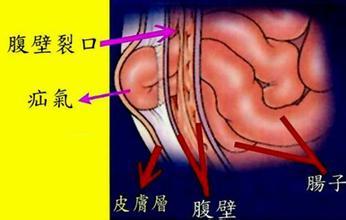 老年人腹壁切口疝用腹带效果如何,腹壁疝术后睡觉要绑腹带吗
