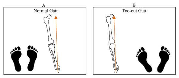 外八字脚会不会影响膝盖,跑步时八字脚产生原因及纠正方法